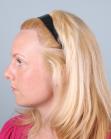 After Hair Transplant&nbsp;Hairline